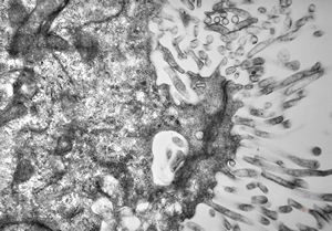 M,12y. | plexus papilloma M,12y. | plexus papilloma